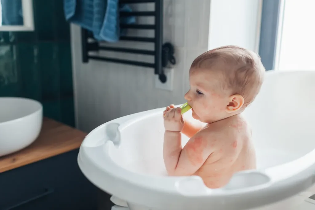 Dermatitis atópica severa