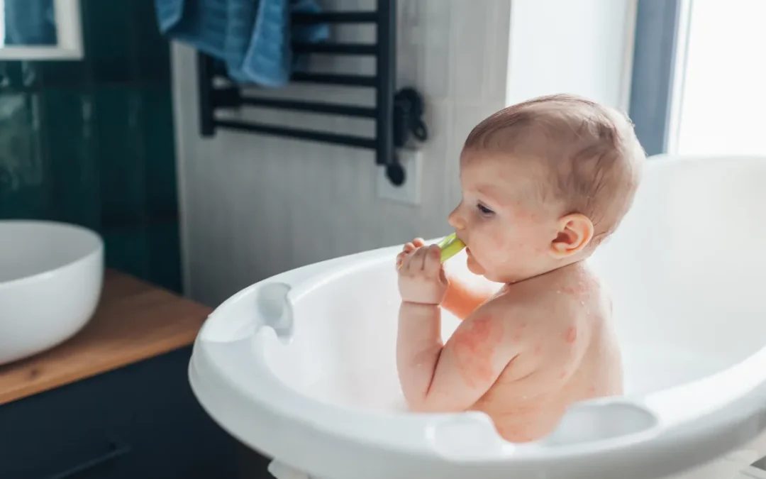 Actualización en el manejo de la dermatitis atópica severa: Más allá de los corticoides